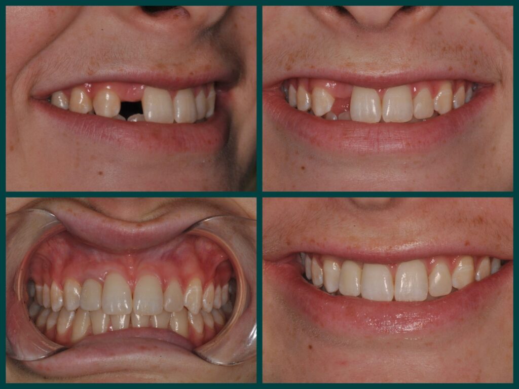 Dental Implants: A Permanent Solution for Missing Teeth